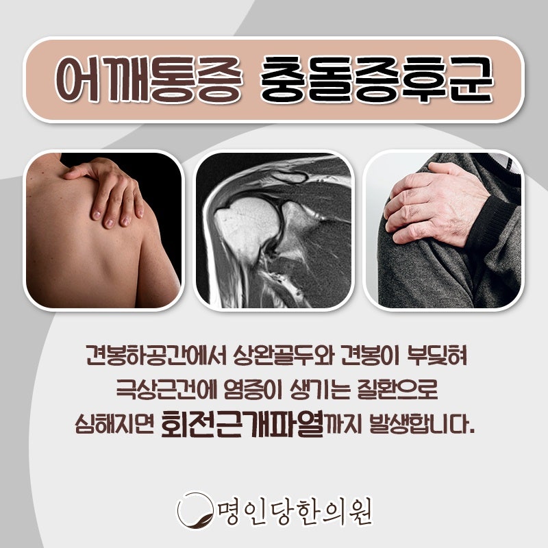 어깨 창원시청 상남동 충돌증후군 팔·손목에도 통증 내려와 몰랐던 정보