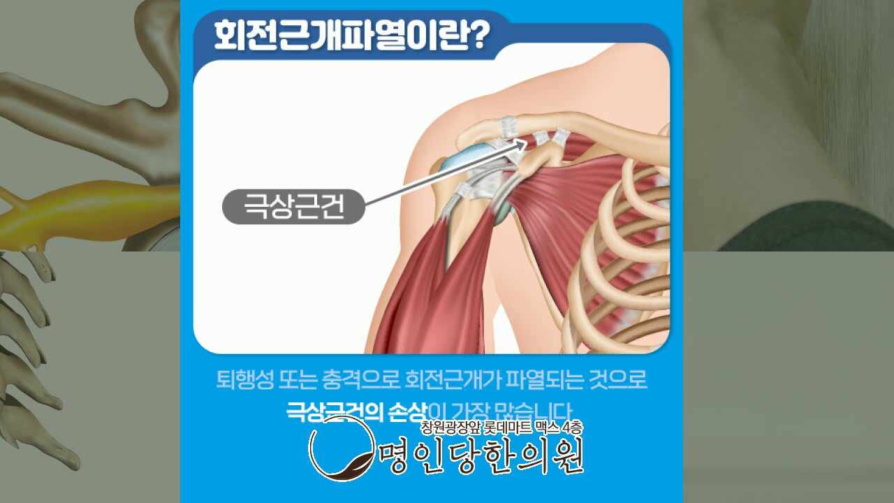 어깨 창원 상남동 회전근개파열 치료 더 미루지 말고, 추나치료 한의원