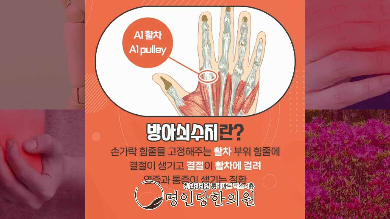 방아쇠수지 손가락 펼때마다 덜컥덜컥, 창원시청 상남동 약침치료 명인당한의원