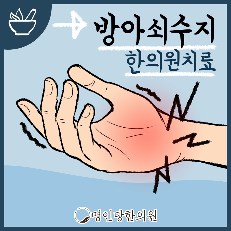 창원시청 상남동 방아쇠수지 손가락에 딸깍하는 마찰음 들린다면 건강정보